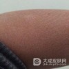 鱼鳞病患者在治疗中要注意什么