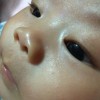 慢性湿疹治疗应该注意些什么？