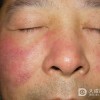 什么会引起接触性皮炎