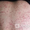 哪些食物毛囊炎患者要远离呢