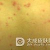 药疹疹型多千变万化
