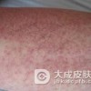 如何及时诊断鉴别药疹反应