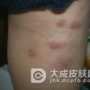 哪些部位易发疥疮结节呢