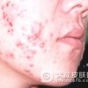 治疗痤疮的常见误区有哪些