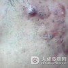 脸上长了痤疮怎么预防比较好呢