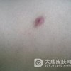 皮肤瘙痒症如何自我护理呢