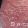 得了尖锐湿疣不治可以吗?