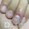 大家对于扁平苔癣这种疾病的危害都了解吗?