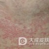 哪些的因素可诱发扁平苔藓?