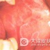 扁平苔藓的症状具体的都有什么呢?