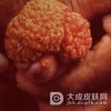 男性尖锐湿疣患者为什么会复发