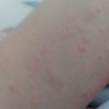 过敏性紫癜如何预防