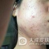 如何辨别真假粉刺