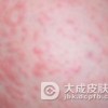 过敏性皮炎的症状表现究竟是什么