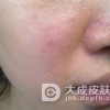 遗传性过敏性皮炎发病后有什么反应