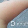 过敏性皮炎的症状特点