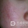 遗传过敏性皮炎有哪些症状