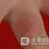 冬季预防冻疮的方法