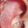 预防冻疮应该怎样做