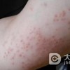 遗传过敏性皮炎患者洗澡时注意些什么？_0
