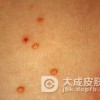 大蒜对于寻常疣的治疗有妙用