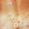 一期梅毒治疗的口服药物推荐
