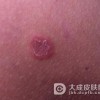 一期梅毒是否可以根治