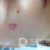 得了寻常疣要怎么治