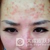 做好过敏性皮炎的保健方法是什么?
