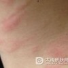 日光性皮炎的护理措施有哪些呢