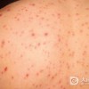 小儿水痘怎么治疗