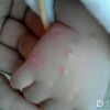 治疗水痘的佳方法是什么啊？