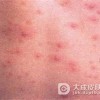 患水痘后该怎样护理？