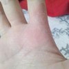 皮肤瘙痒的具体症状有哪些