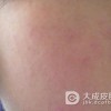 皮炎反复发作的原因