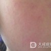 毛囊虫皮炎病因有哪些