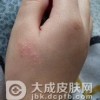 皮肤瘙痒的主要的症状有哪些呢?