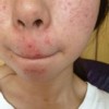 毛囊堵塞形成的痤疮有哪些表现