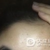 聚合性痤疮从轻到重的一系列症状表现