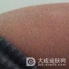 鱼鳞病是怎么引起的