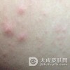 小儿皮炎怎么治