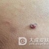 平时怎么预防寻常疣
