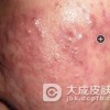 青春痘误区有哪些