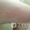 红斑狼疮怎么调养比较有效呢