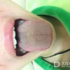 男、女性梅毒不同早期症状