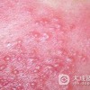 生殖器疱疹早期症状描述