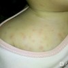 湿疹患者日常应当注意什么