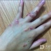 湿疹患者护理重点