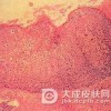 采用什么药物治疗尖锐湿疣好呢