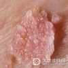 护理尖锐湿疣可采取哪些措施